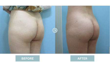 Hip Lifting Korea (Brazilian Butt Lift) - Apple Hip Lift