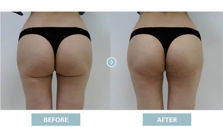 Hip Lifting Korea (Brazilian Butt Lift) - Apple Hip Lift