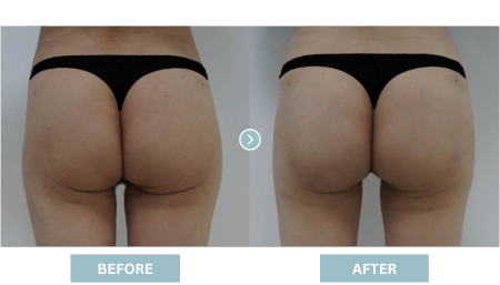 Hip Lifting Korea (Brazilian Butt Lift) - Apple Hip Lift