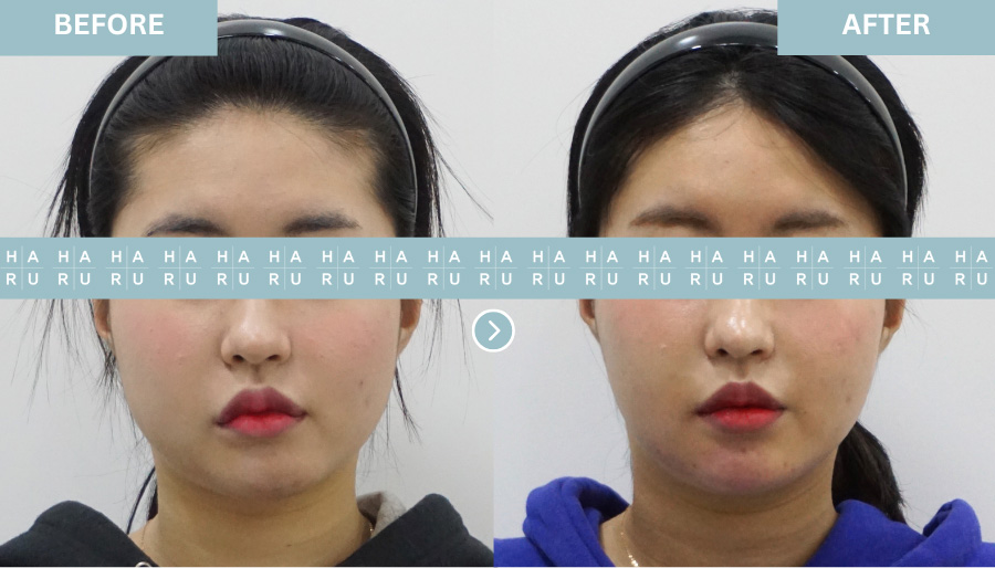 Point V Chin & Lip Asymmetry Correction