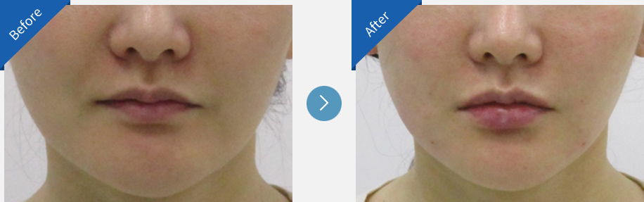 lip asymmetry correction in korea before and after haru clinic