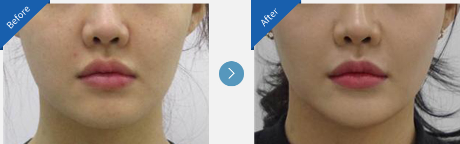 lip asymmetry correction in korea before and after haru clinic
