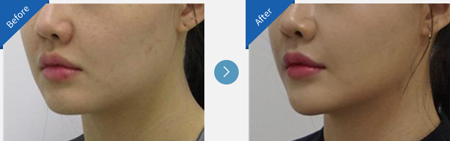lip asymmetry correction in korea before and after haru clinic