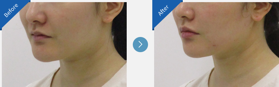 lip asymmetry correction in korea before and after haru clinic