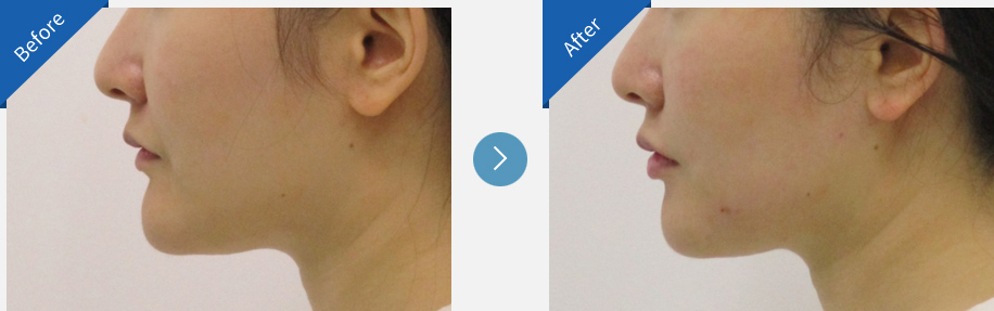 lip asymmetry correction in korea before and after haru clinic