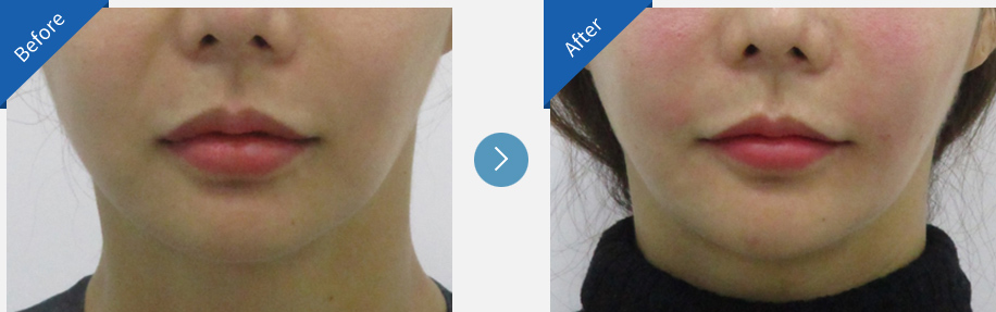 lip asymmetry correction in korea before and after haru clinic