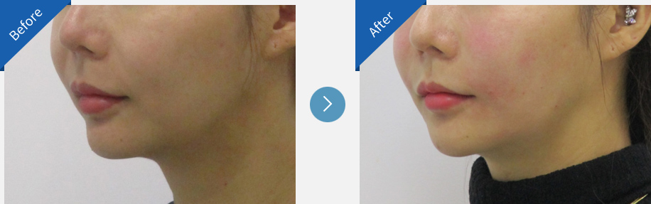 lip asymmetry correction in korea before and after haru clinic