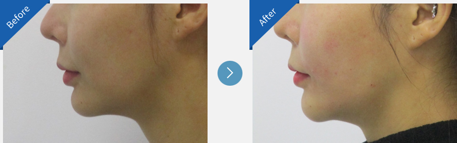 lip asymmetry correction in korea before and after haru clinic