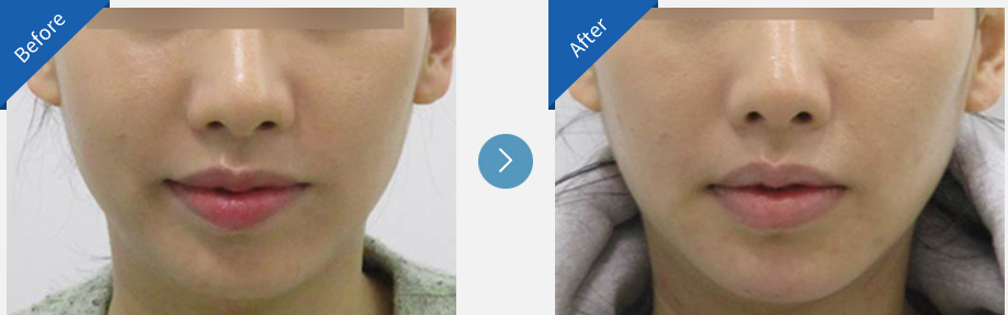 lip asymmetry correction in korea before and after haru clinic