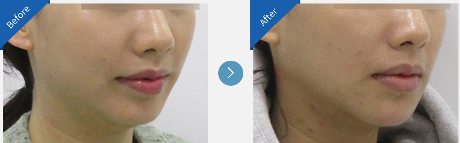lip asymmetry correction in korea before and after haru clinic