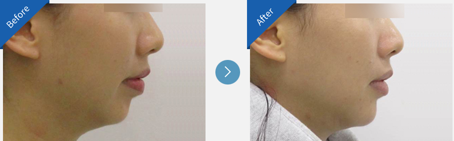 lip asymmetry correction in korea before and after haru clinic