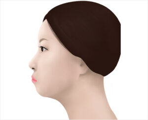 lip asymmetry correction in korea haru clinic