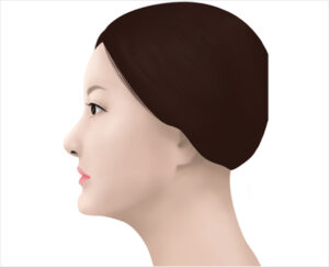 lip asymmetry correction in korea haru clinic