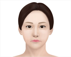 lip asymmetry correction in korea haru clinic