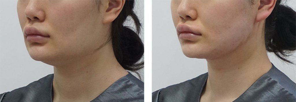 collagen tightening korea - Collagen Tightening