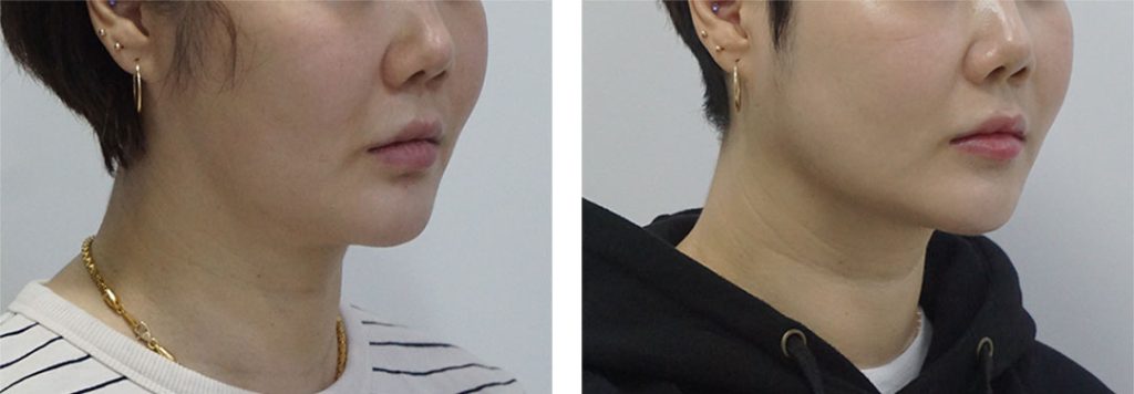 collagen tightening korea - Collagen Tightening