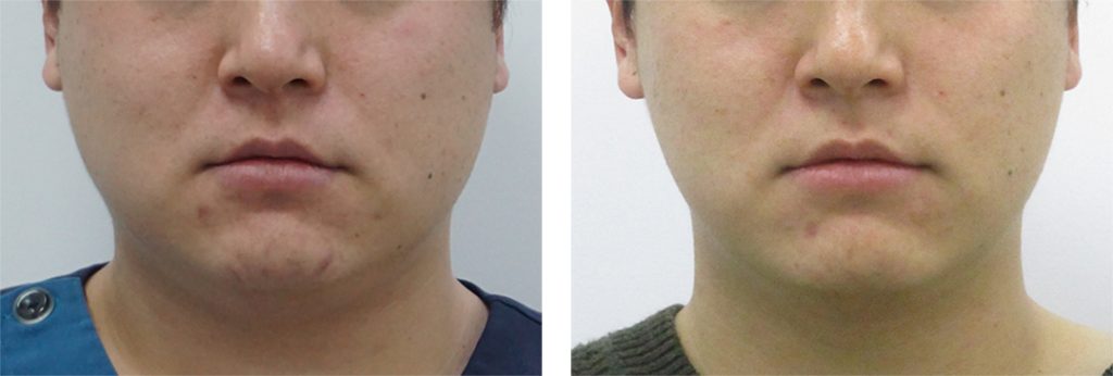 collagen tightening korea - Collagen Tightening