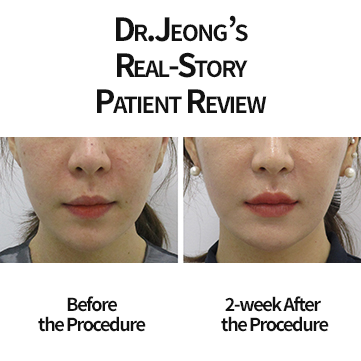 Haru Philtrum Shortening Lift