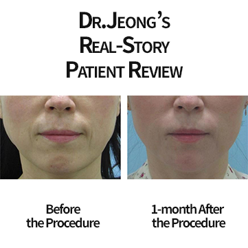 Haru Collagen Skin Tightening