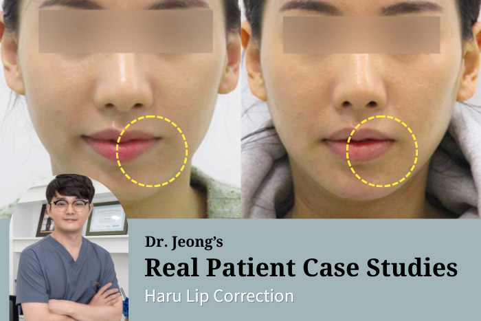 Haru Lip Correction