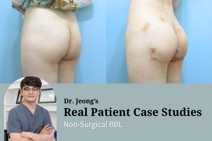 One-Day Non-Surgical BBL for Immediate Contour Improvement at Haru Clinic, Korea