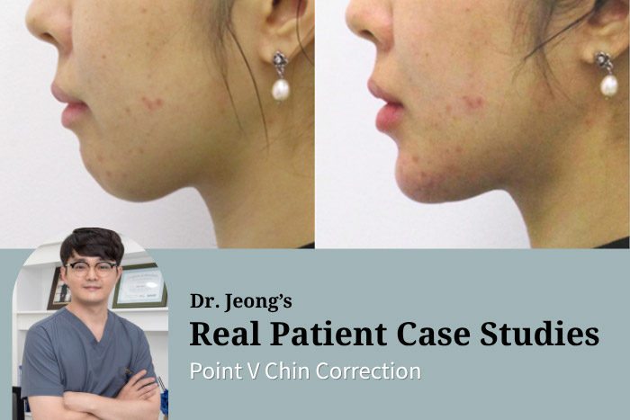 Point V Chin Correction: Non‑Surgical Chin Contouring with Semi‑Permanent Threads at Haru Clinic