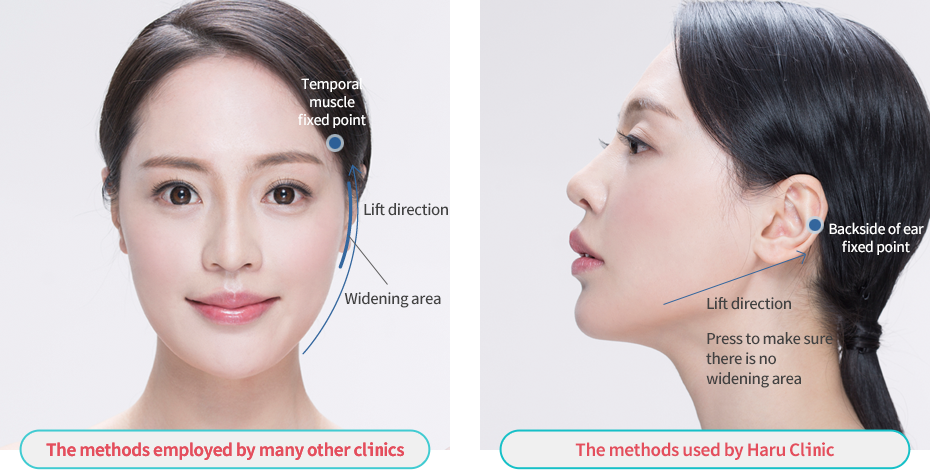 pro thread lift in korea Haru Clinic gangnam seoul