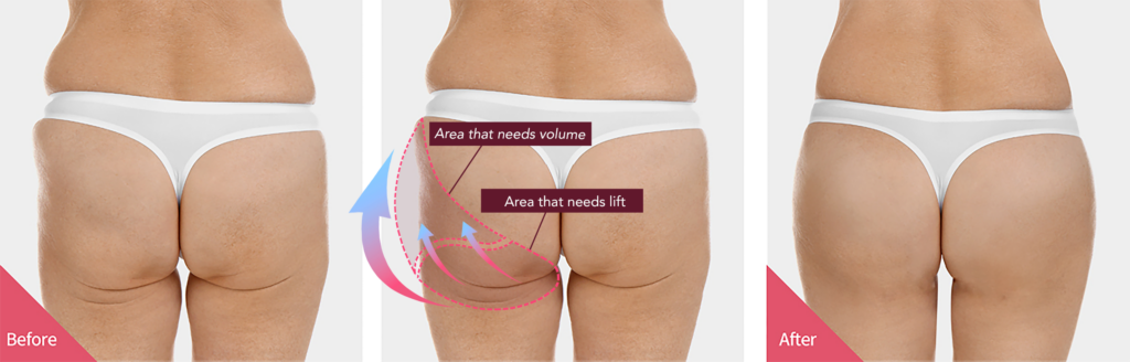 non surgical bbl in korea Haru Clinic gangnam seoul