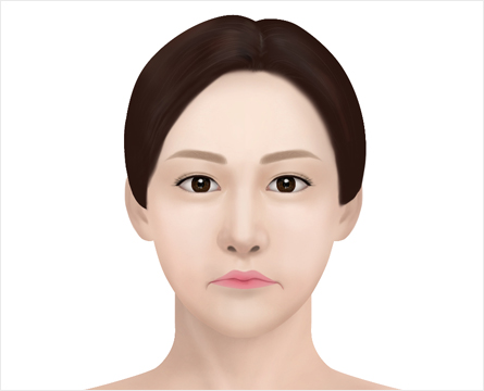 non surgical lip lip in korea Haru Clinic gangnam seoul