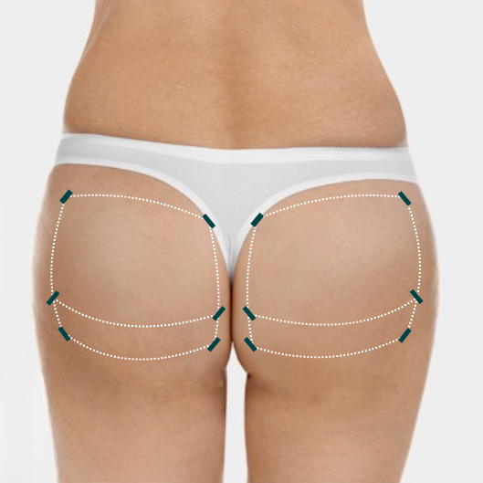 non surgical bbl in korea Haru Clinic gangnam seoul