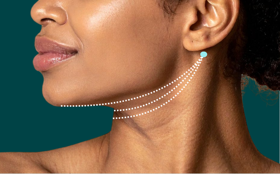 double chin thread lift in korea haru clinic gangnam seoul