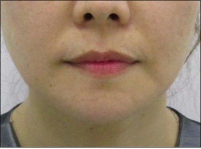 Philtrum Reduction Lifting: Non-Surgical Thread Lift for a Shorter, More Defined Upper Lip — Haru Clinic, Korea