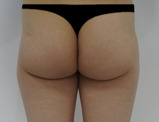 One-Day Non-Surgical BBL: Thread Butt Lift at Haru Clinic, Korea