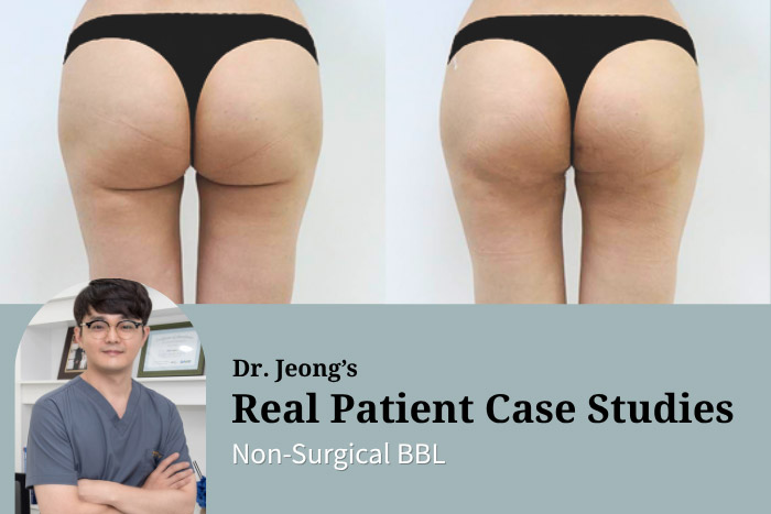 One-Day Non-Surgical BBL: Fix Buttock Sagging After Thigh Liposuction