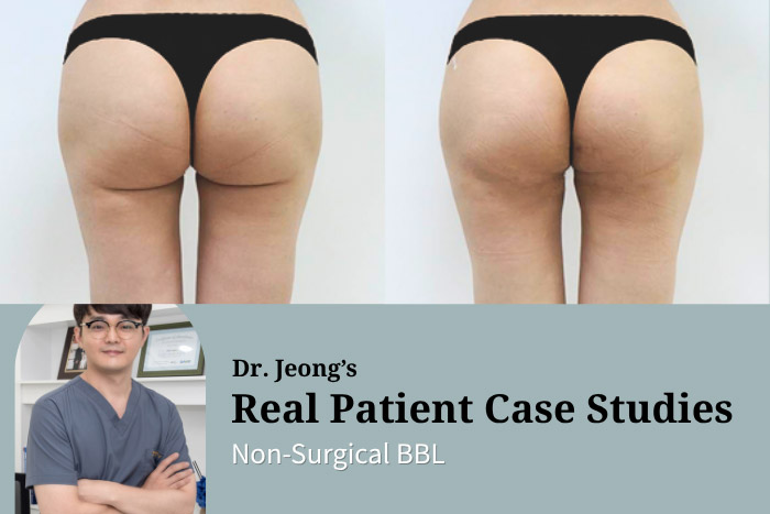 One-Day Non-Surgical BBL: Fix Buttock Sagging After Thigh Liposuction