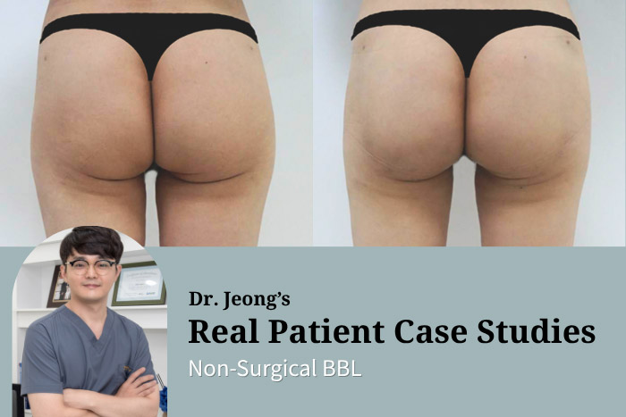 One-Day Non-Surgical BBL Case in Korea: Fixing Buttock Sagging and Asymmetry