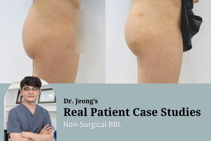 One-Day Non-Surgical BBL: Thread Butt Lift at Haru Clinic, Korea