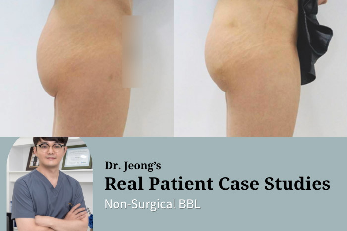 One-Day Non-Surgical BBL: Thread Butt Lift at Haru Clinic, Korea