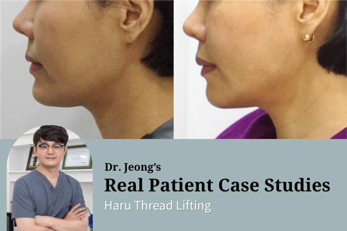 Thread Lifting at Haru Clinic: Customized Thread Lift in Korea for Enhanced Jawline Definition