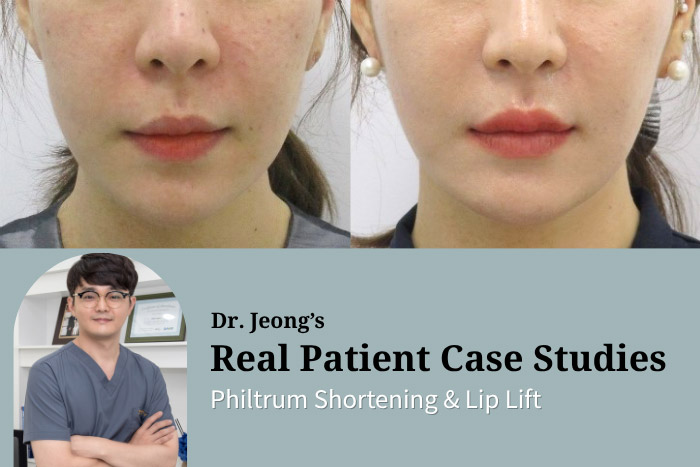 Philtrum Shortening Lift: Non-Surgical Thread Lift to Shorten and Define the Upper Lip