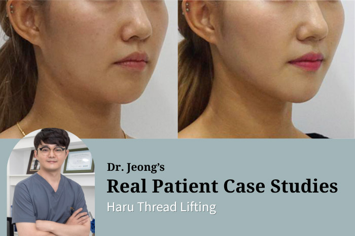 Haru Thread Lifting: Thread Lift for a Defined Jawline & Double Chin Reduction