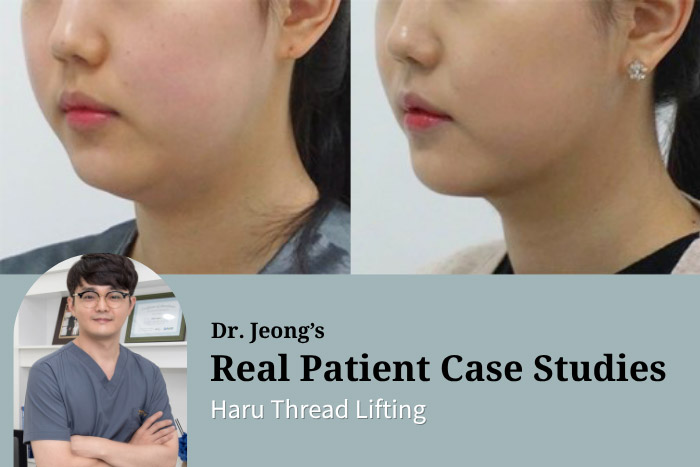 Haru Lifting Thread Lift in Korea: Non-Surgical Treatment for Double Chin and Jawline Definition