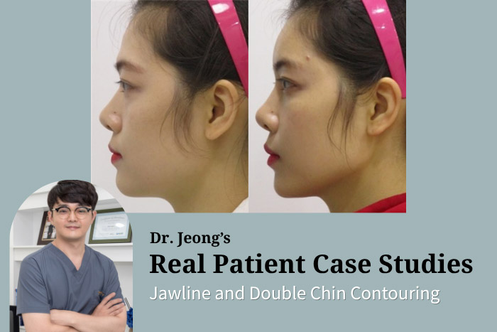 Full-Face Fillers & Thread Lifting: Natural Facial Rejuvenation at Haru Clinic in Korea