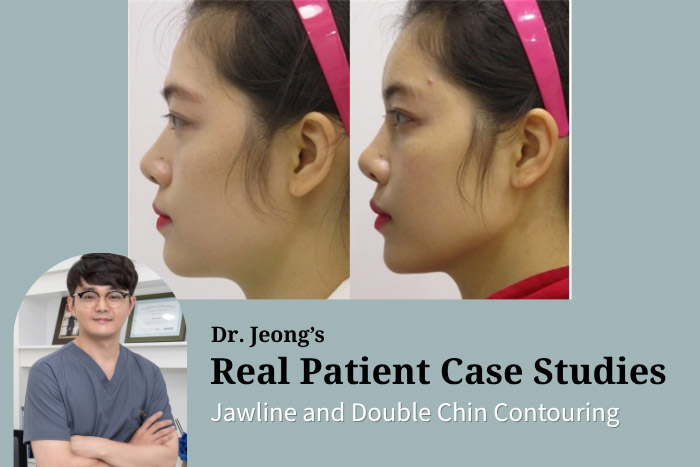 Full-Face Fillers & Thread Lifting: Natural Facial Rejuvenation at Haru Clinic in Korea