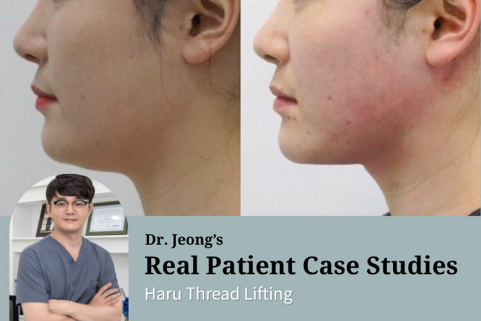 Haru Thread Lifting: Dissolvable Thread Lift for V-Line Definition and Double Chin Contouring