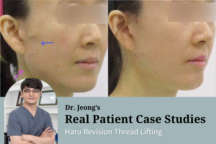 Revision Thread Lifting After Another Clinic: Case Review on Thread Removal and Uneven Facial Contour Correction