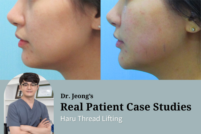 Haru Thread Lifting in Korea — Natural Facial Contouring with Dissolvable Threads