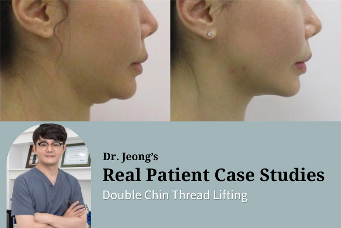 Neck Wrinkle & Double Chin Thread Lifting at Haru Clinic — Minimally Invasive Neck Lift for a Sharper Jawline