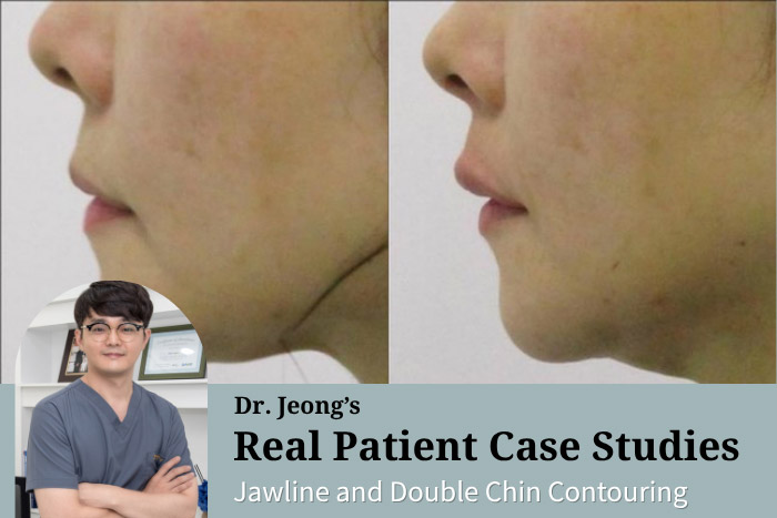 Philtrum Reduction Lifting: Non-Surgical Thread Lift for a Shorter, More Defined Upper Lip — Haru Clinic, Korea