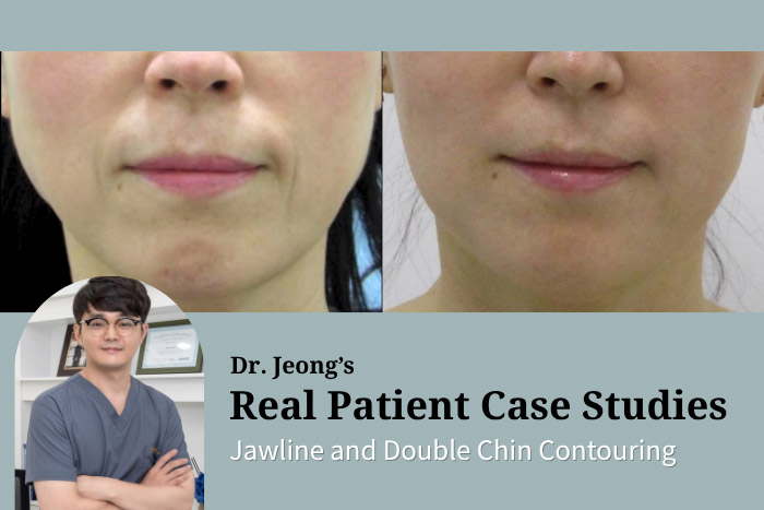 Collagen Tightening Injections: 5-Month Results — Natural Lower-Face Firming with Collagen-Stimulating Filler at Haru Clinic, Korea